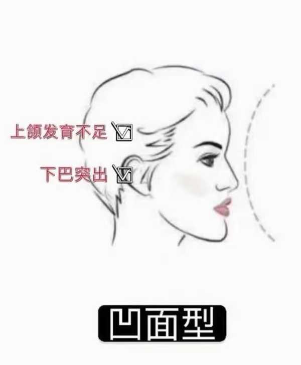 牙齿矫正肖家良 的想法: 根据侧貌凸度,可以将面型分为三种:【第