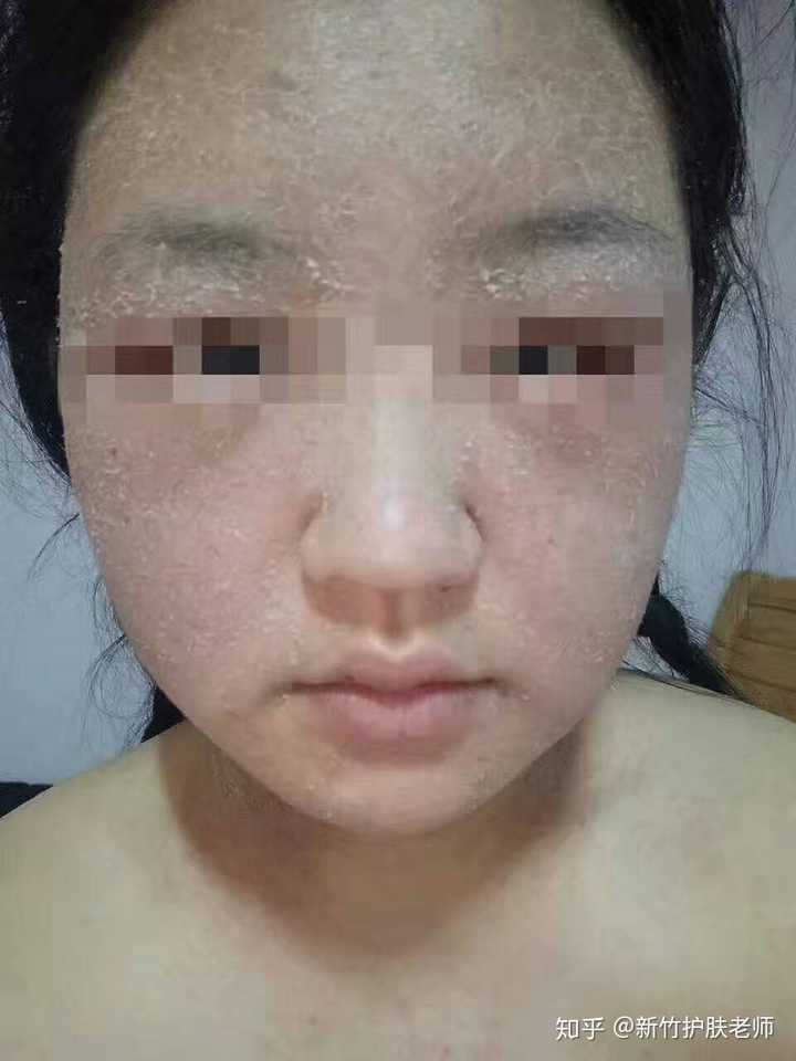 激素脸怎样修复?