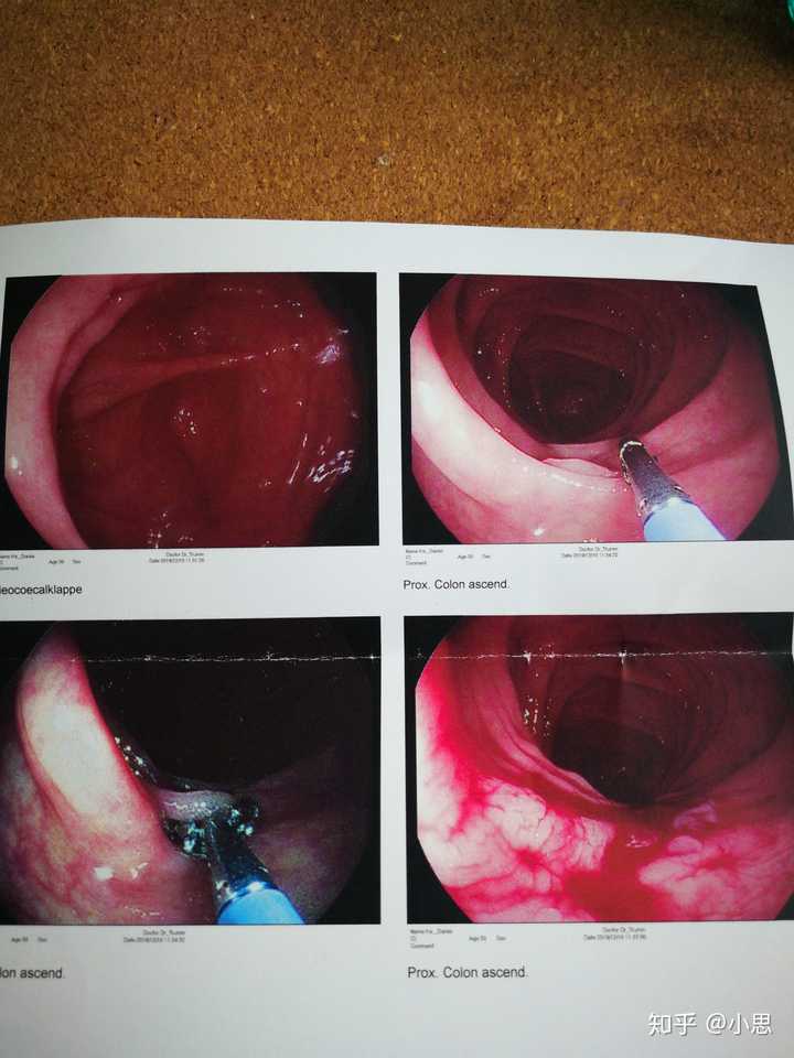 左上普通肠,右上发现息肉,左下割息肉,右下割完出血.