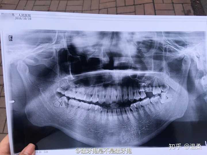 长四颗智齿是怎样的体验?