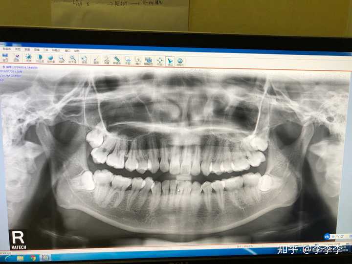 刚拍的,下牙俩都是横着的,还没想好拔不拔