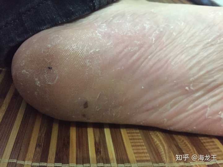 脚气一直不是很严重,也没有得到好的治疗,造成脚后跟脚侧角质层增厚