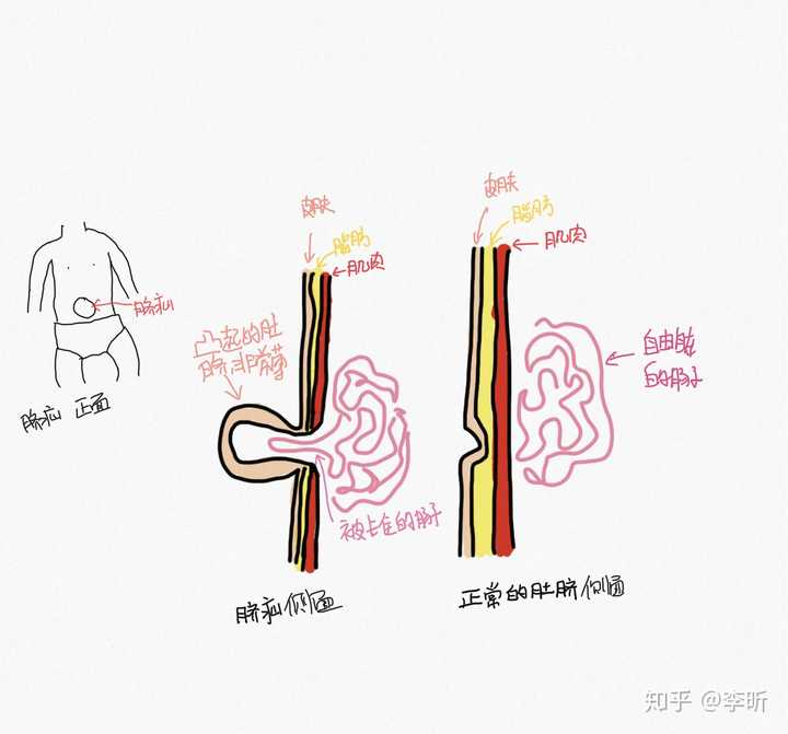 脐疝示意图 自己画的