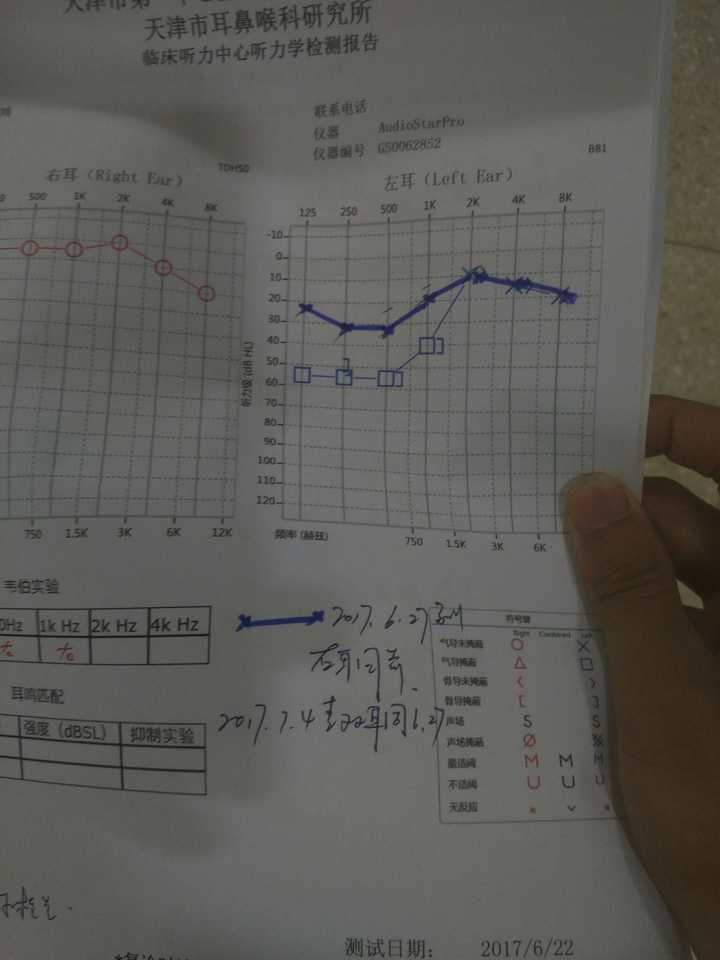 典型左耳 低频下降纯音听力测试.