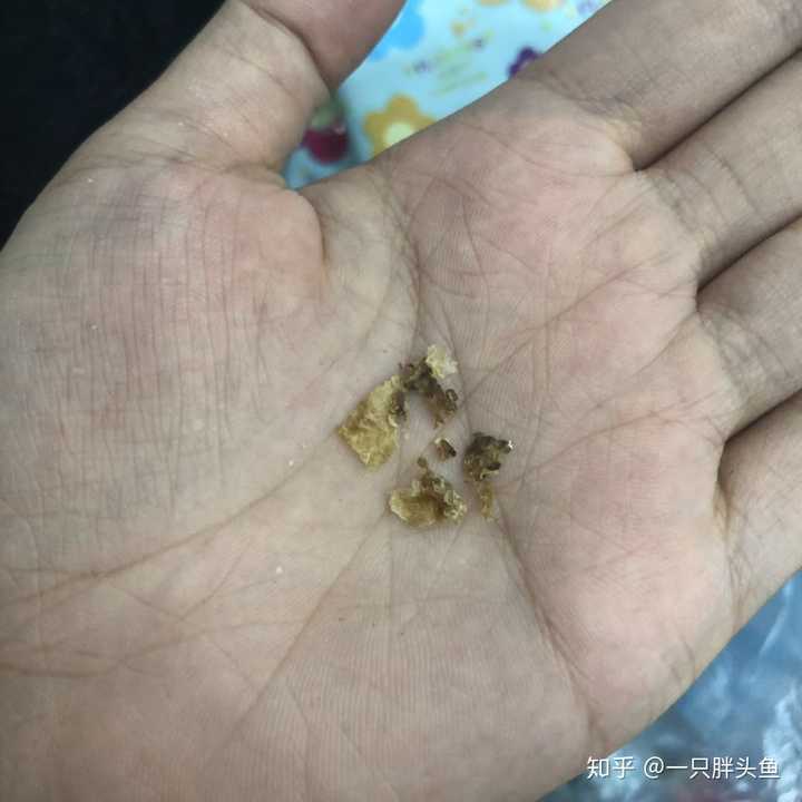 耳屎能大到什么程度?