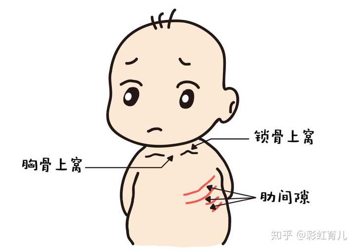 医生通常会使用迅速起效的激素 来快速解除宝宝喉部水肿阻塞.