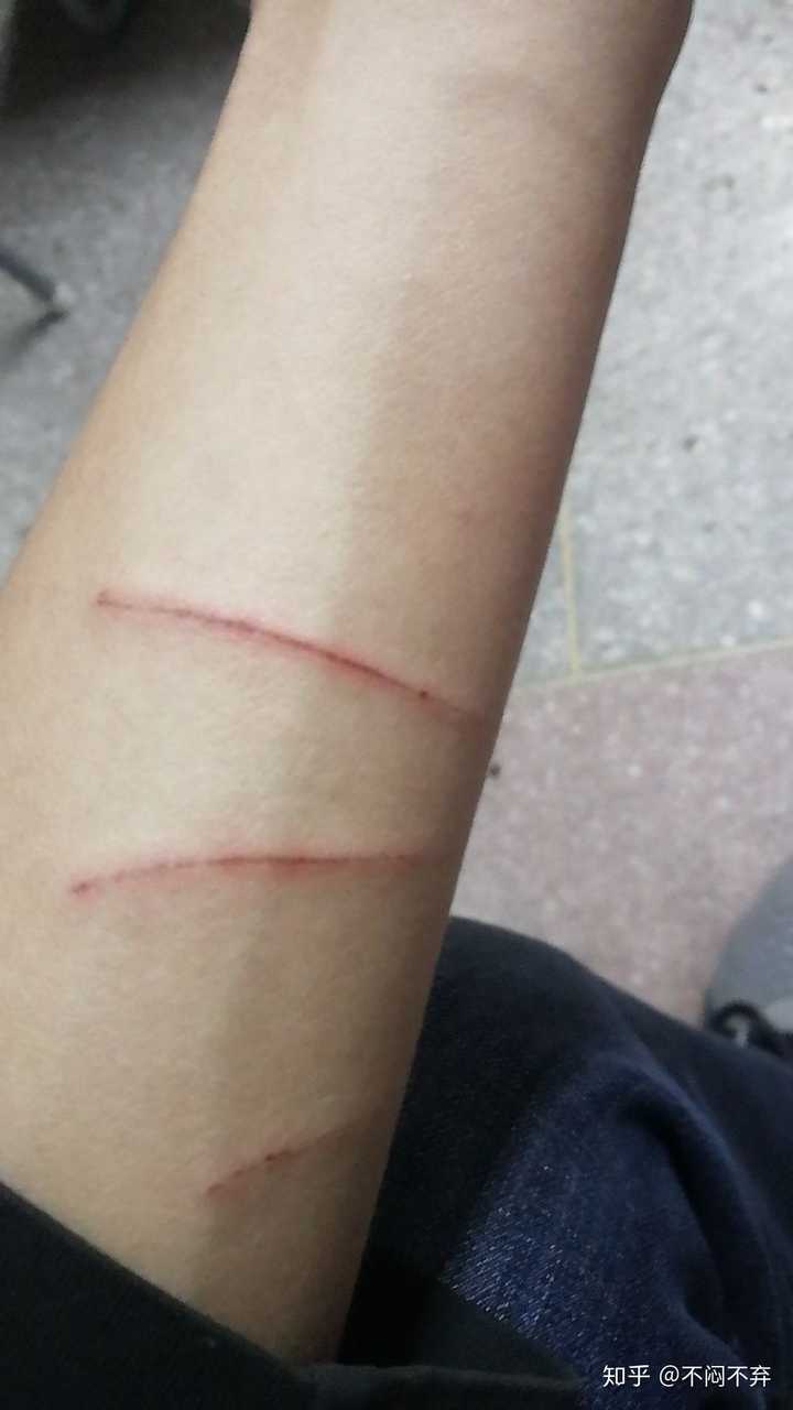 被兔子挠伤用不用打狂犬疫苗?
