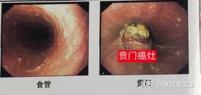 胃癌肝多发转移但患者没有明显症状