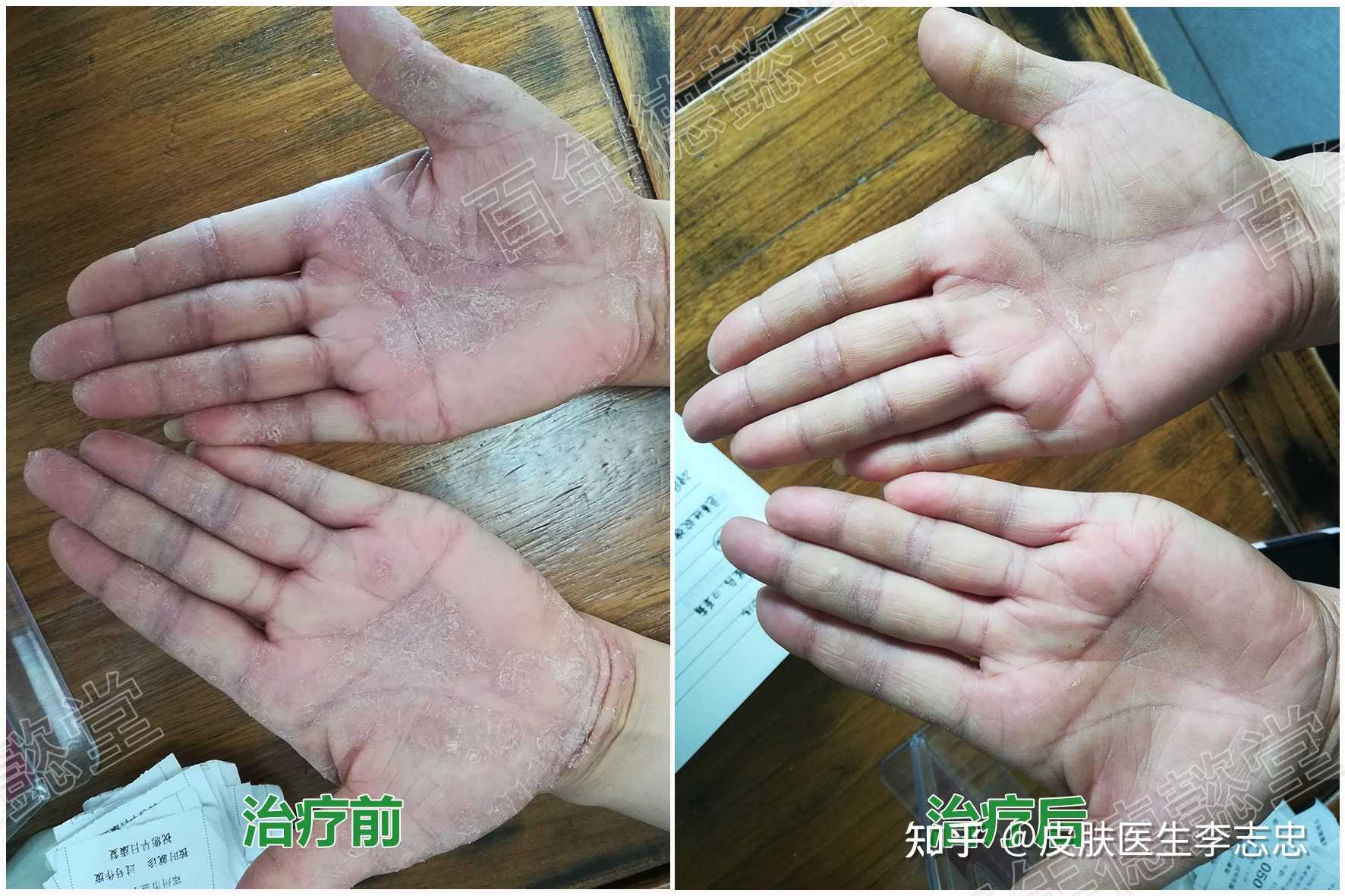 皮肤医生李志忠 的想法: 神经性皮炎合并皲裂性湿疹