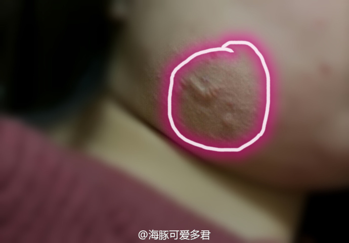 增生性疤痕能治疗好吗?