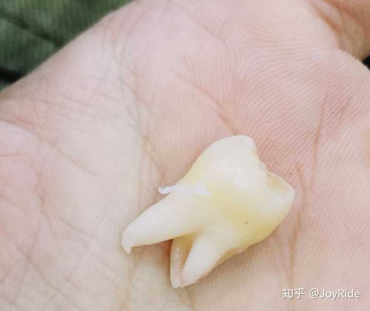 下牙被碎成了八九块,我已经懒得拿走了,上牙拿回来了  三个牙根