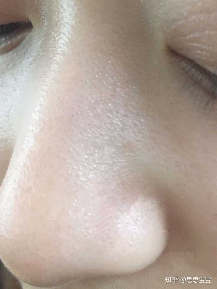 鼻子的周围却出现了密密麻麻的黑头,我至今怀疑,当年的生理学老师是不
