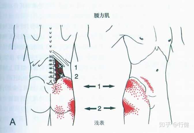 比如:腰方肌