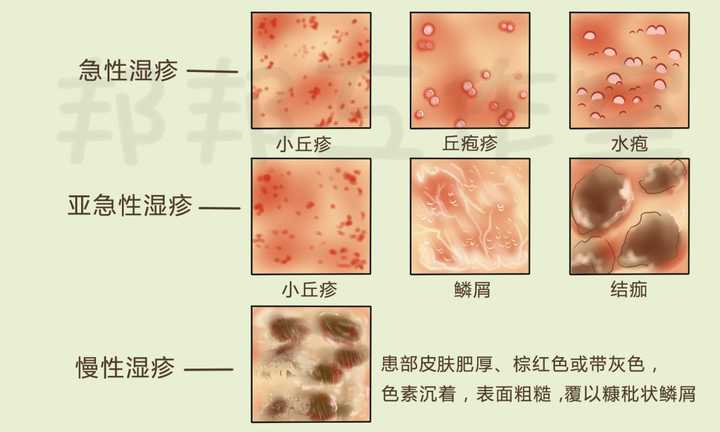 为什么会突然长湿疹?