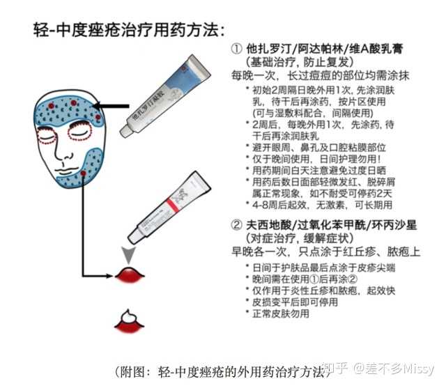 他扎罗丁乳膏和阿达帕林凝胶,相比维a酸乳膏,化学性质更为稳定,不易