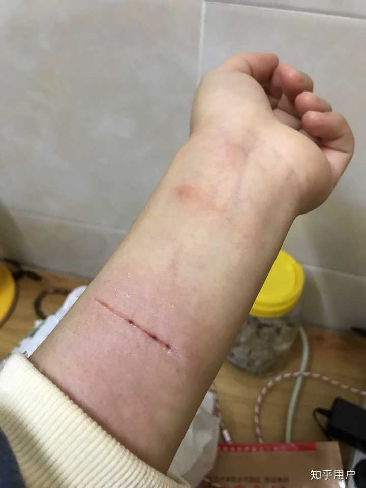 自残的人是什么心理?