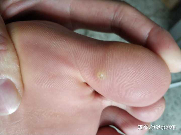 贴了三盒鸡眼贴了! 刚刚开始是这样的