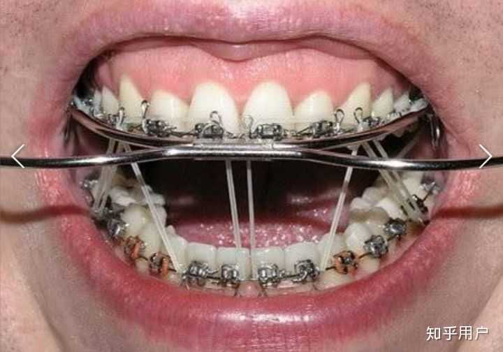 龋齿很多的成年人可以戴牙套吗?