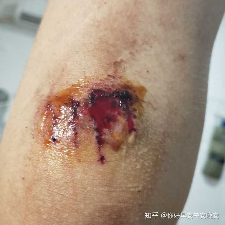 膝盖摔伤抹了碘伏结痂后如何防止留疤