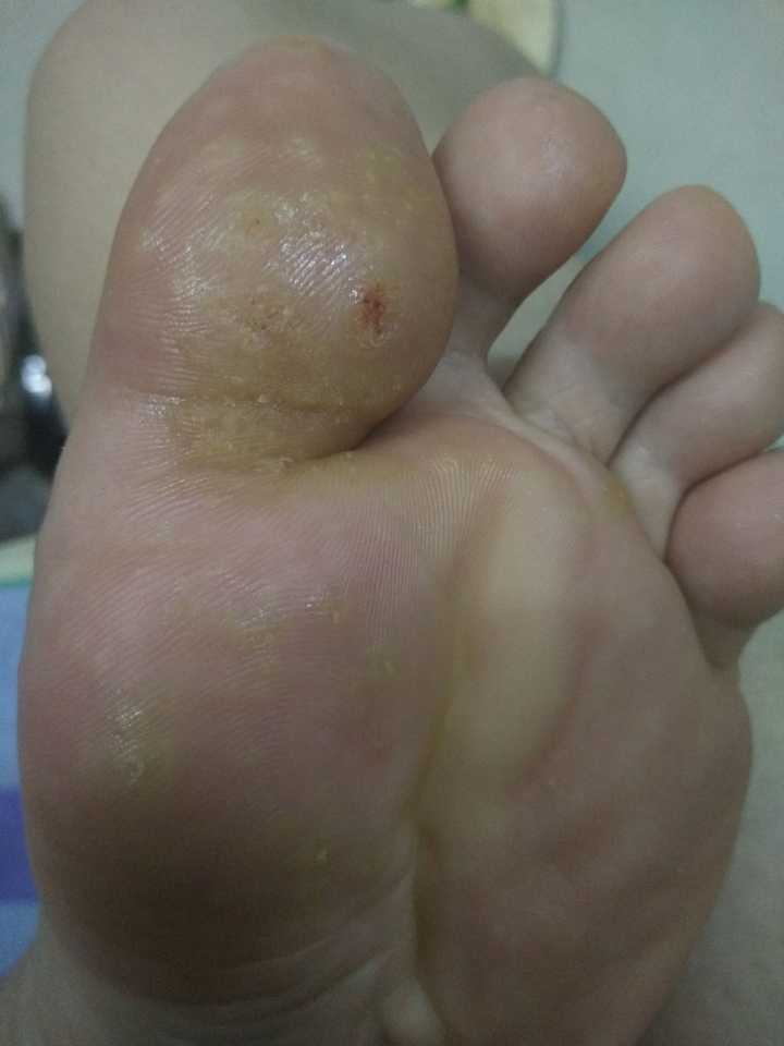 跖疣怎么治疗?