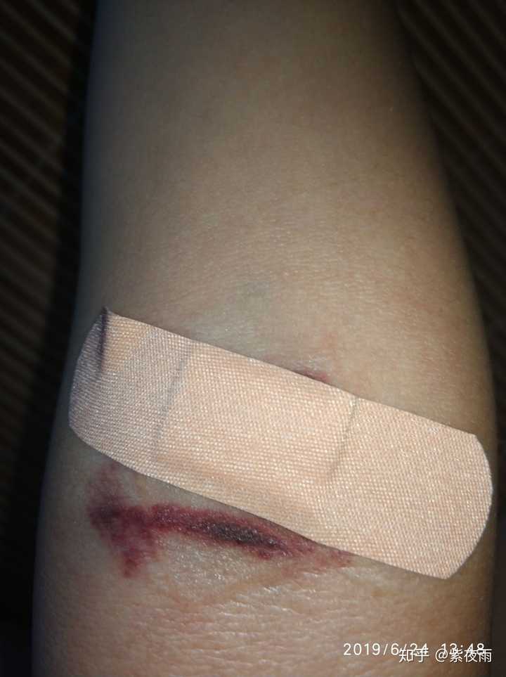 这是被扎坏的右手臂   血痂被一起带下来了 还有点冒血  就贴了个