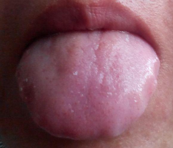 胖大舌 胖大舌:舌体虚浮胖大,或边有齿痕,色淡而嫩的称胖大舌.