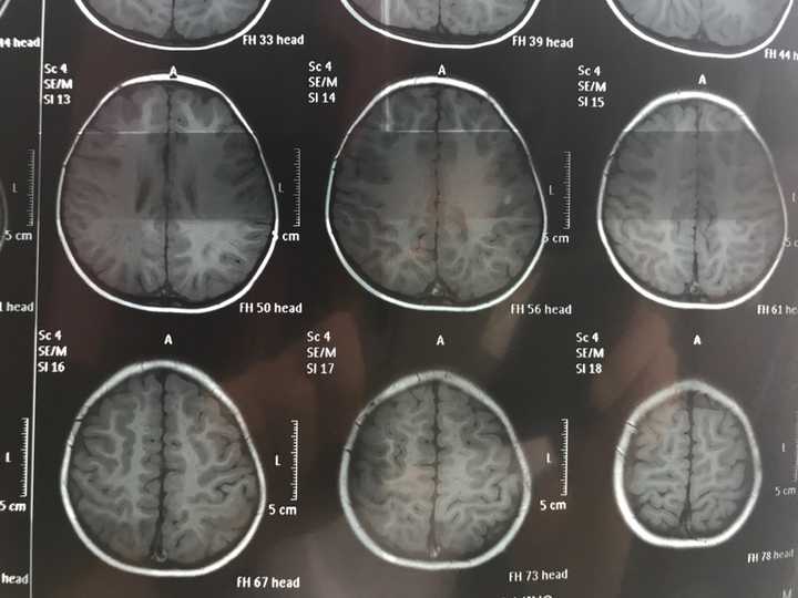 磁共振,双侧半卵圆中心及侧脑室后角旁白质异常信号,考虑扩大的血管