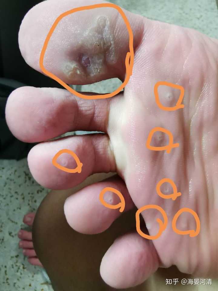 跖疣的自愈性大吗?