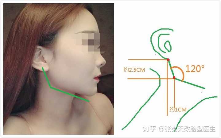 适合做颧骨和下颌角磨骨吗?