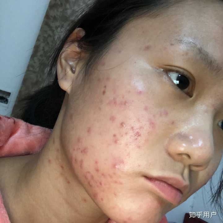 想去针清做过的人有效果吗