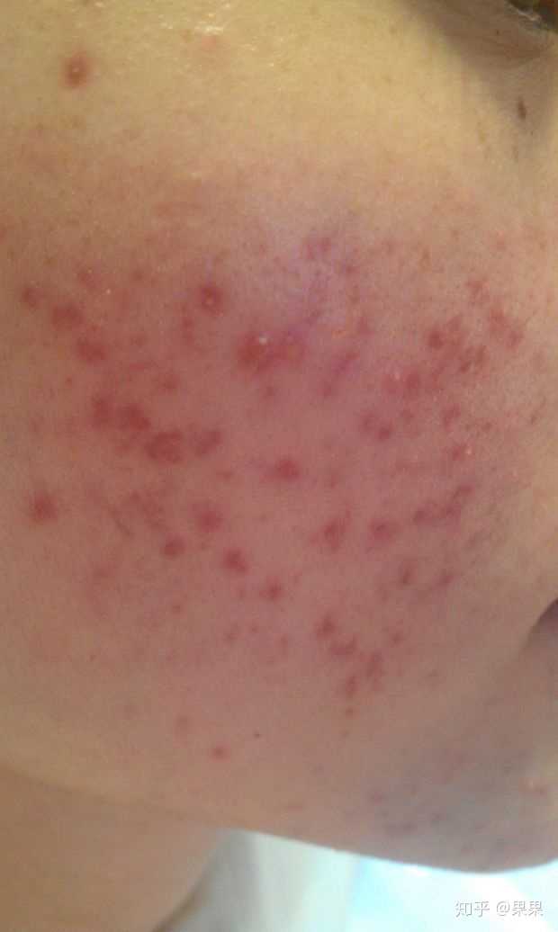 你的红色的痘印其实是皮下的淤血和炎症,就是毛孔里面有炎症,炎症没