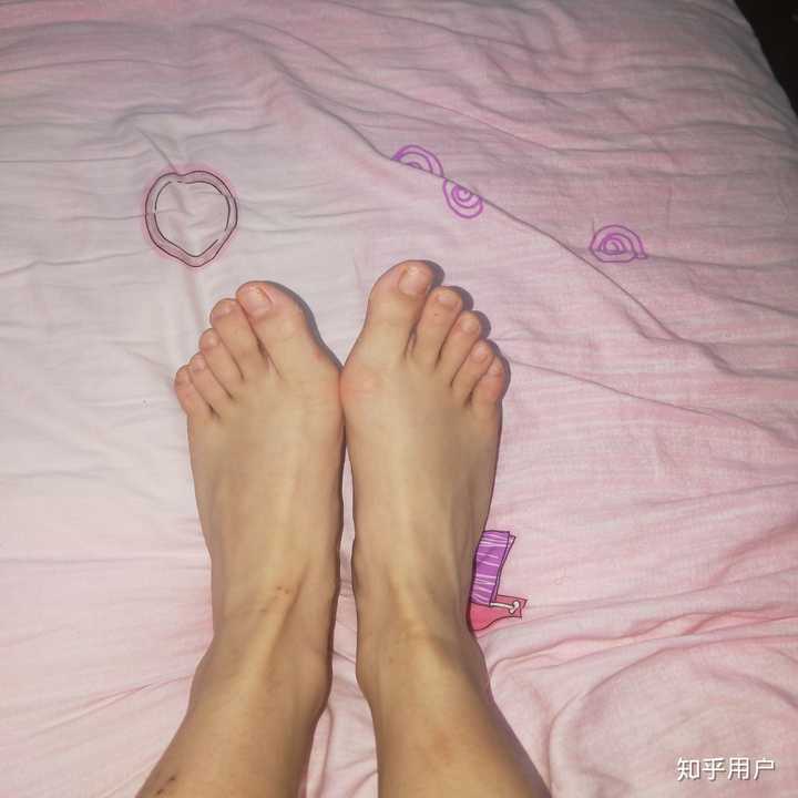 女生脚趾拇外翻是什么样体验?