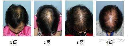 朋友们这算脱发严重吗,头发一天就油的不行,又软又少