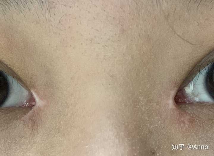 如何去除或淡化眼角白色疤痕?