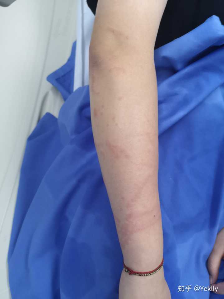 被水母蛰是一种什么体验?