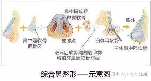 你大概是害怕做完鼻子会不会影响鼻腔共鸣和发声吧,其实有时候我们把