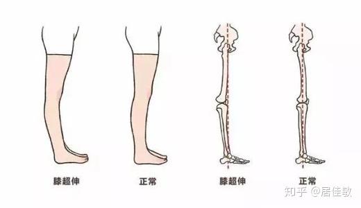 膝超伸不是膝盖错位的问题嘛为什么可以通过锻炼改善?