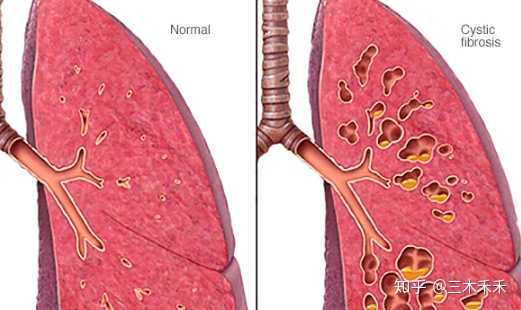 正常肺部vs囊性纤维化