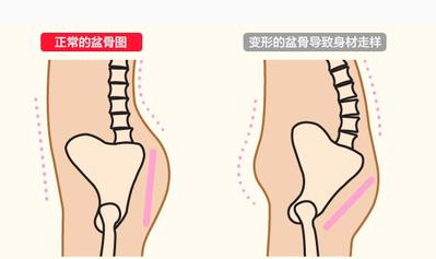 盆底肌训练可以缓解孕晚期耻骨疼痛吗?