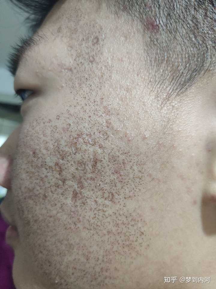 点阵激光去痘坑的效果如何?