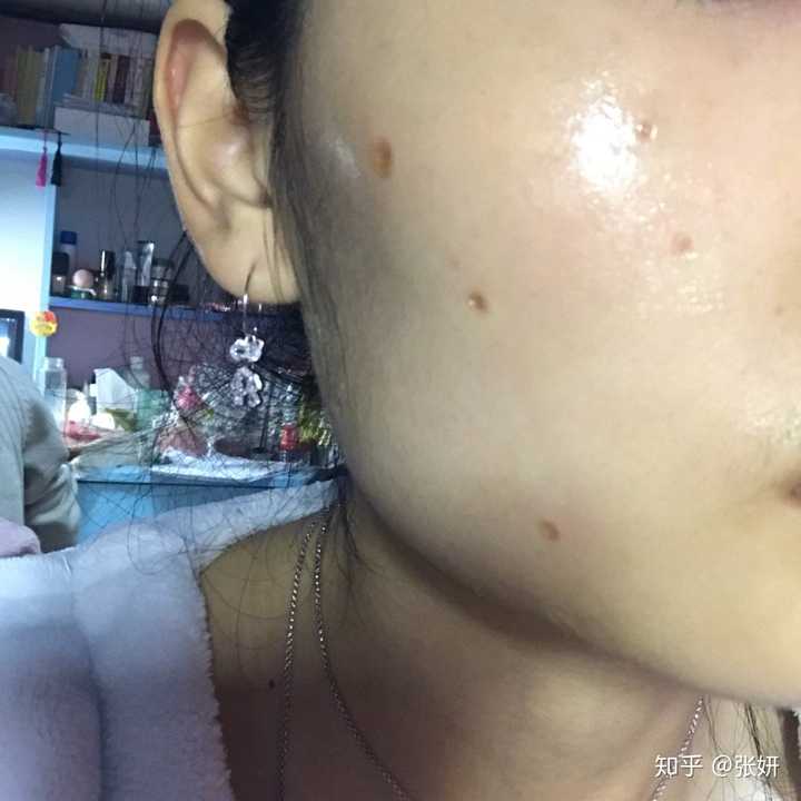 点痣后恢复过程特别痛苦,分享我的点痣经历.