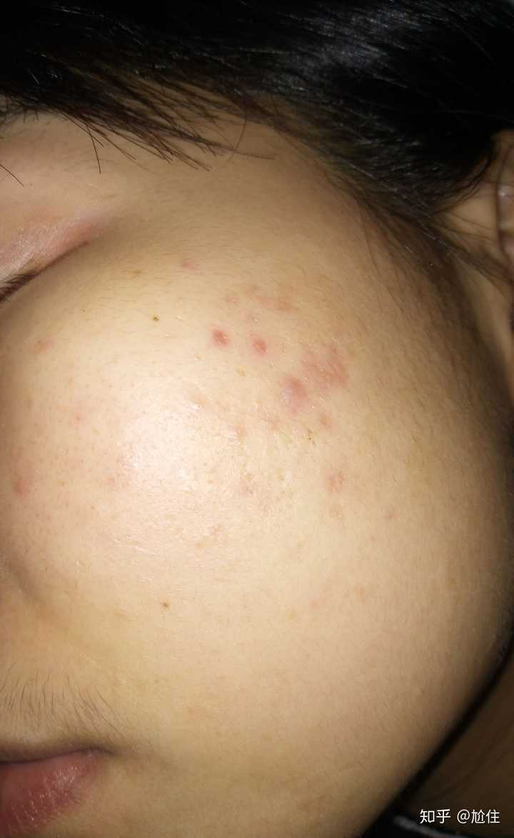有什么好的方法可以祛痘让皮肤变好?