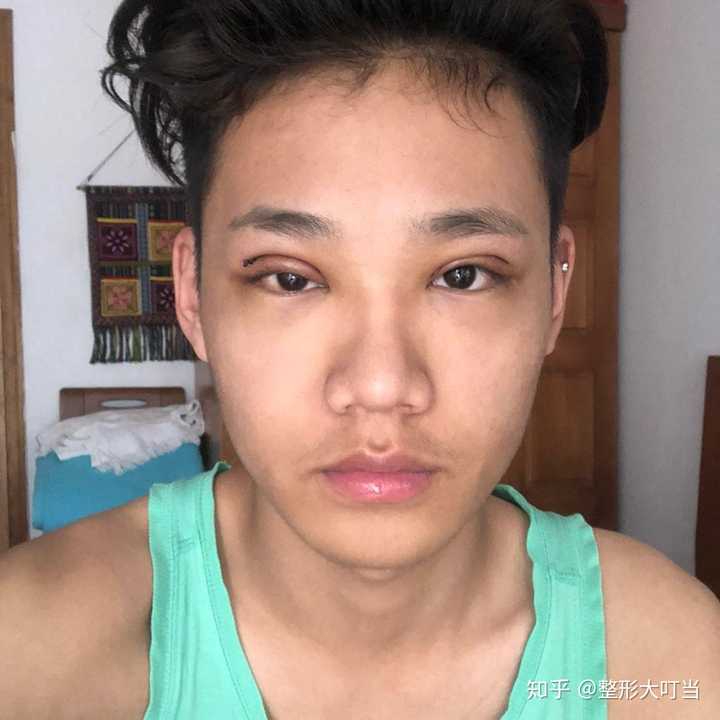 男生可以割双眼皮吗?
