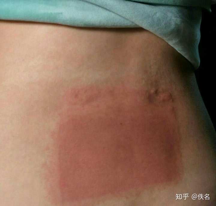 贴膏药过敏怎么办?