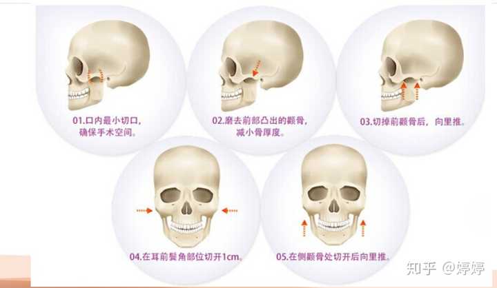 至于颧骨手术开口在哪里,又大概是怎么做的,与其文字表达,不如我找了