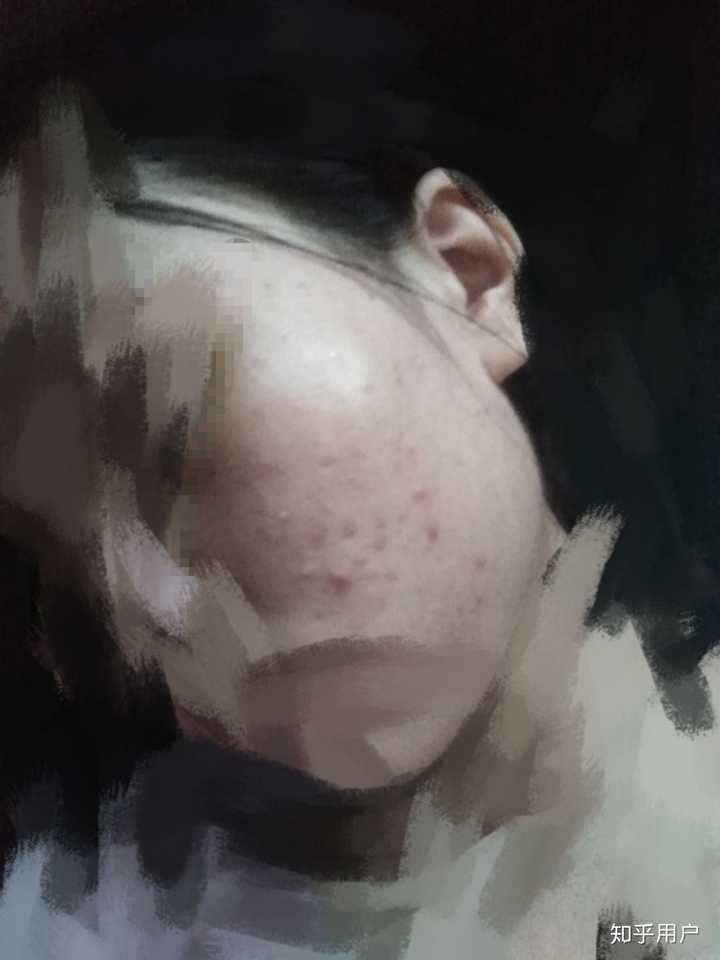 脸上有痘痘的女孩会有男生喜欢吗?
