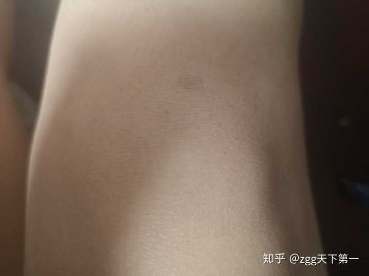猛答一波 我左右膝盖上都有胎记在上面,让我从小一度以为每个人膝盖上