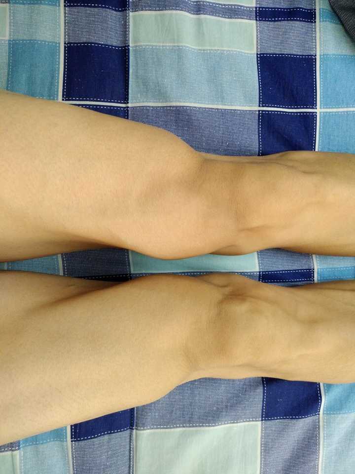 膝盖积液是一种怎样的体验?