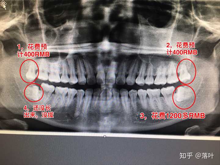 1,先介绍一下我牙齿的情况 请看牙片,上面2颗是都长出来的智齿,上面