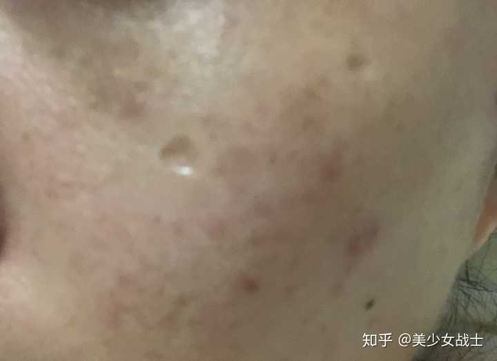 激光点痣留坑了怎么办?